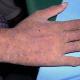 Braune Flecken auf der Haut: Was ist das, warum erscheinen sie und wie werden sie behandelt?