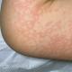 Behandlung von allergischen Hautausschlägen bei Kindern